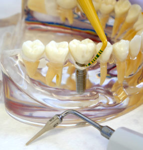 Implantate pflegen – Periimplantitis den Kampf ansagen