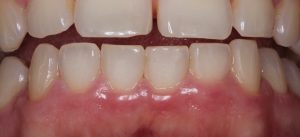 Refresh: Kontrolle von Zahnhartsubstanz und Weichgewebe