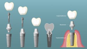 Zahnimplantate: Welche Vorteile haben sie?