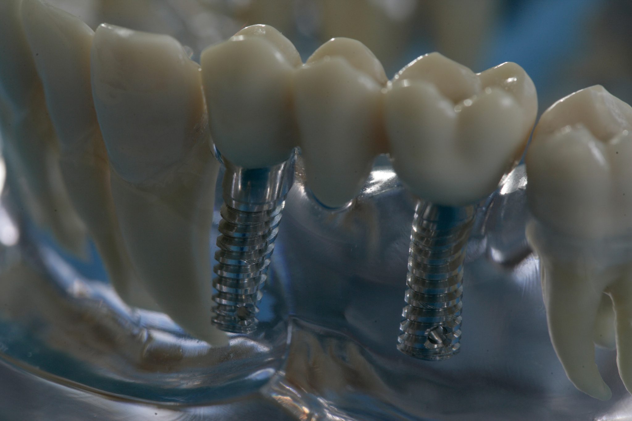 Zahntechniker fertigen Zahnersatz auf Implantaten.