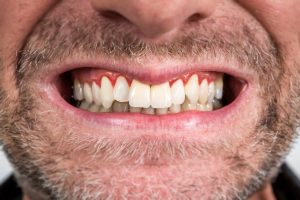 Verantwortlich für eine Parodontitis sind Bakterien, die an den Zähnen anhaften. Die Bakterien schließen sich zu einem Biofilm zusammen. Werden sie nicht durch die tägliche Mundhygiene entfernt, wachsen sie weiter und sind als weiche sowie harte Beläge (Zahnstein) auf den Zähnen und in den Zahnzwischenräumen mit bloßem Auge sichtbar. Der Körper reagiert auf die Bakterien mit einer Zahnfleischentzündung. So kämpft er gegen diese an. Das Zahnfleisch ist rot, geschwollen und kann leicht bluten.
