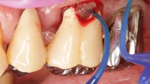 Palliative Parodontitistherapie: Strategien für Zahnerhalt bei fortgeschrittener Parodontitis.