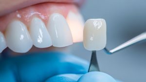 Versorgung mit Veneers nach der GOZ-Nr. 2220
